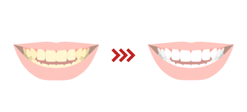 医療ホワイトニングによる本格ケア