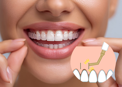 短期間(加速矯正オプション)