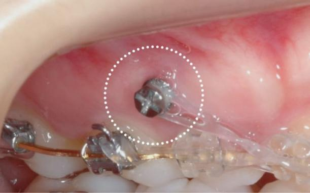 抗生物質・鎮痛剤の処方を行い、清掃などの指導を行います。