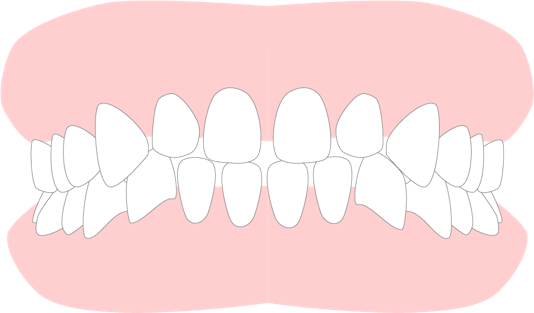 1.前歯のすきっ歯