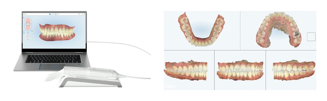 先進的3D口腔内スキャナー「iTero」導入