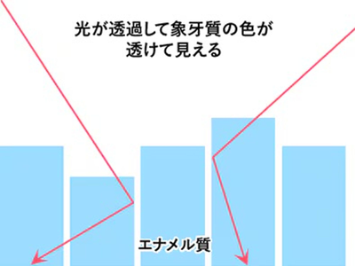 光が透過して象牙質の色が透けて見える状態