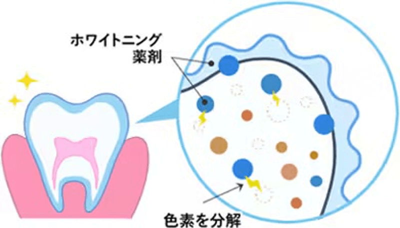 ホワイトニング薬剤により色素を分解した状態