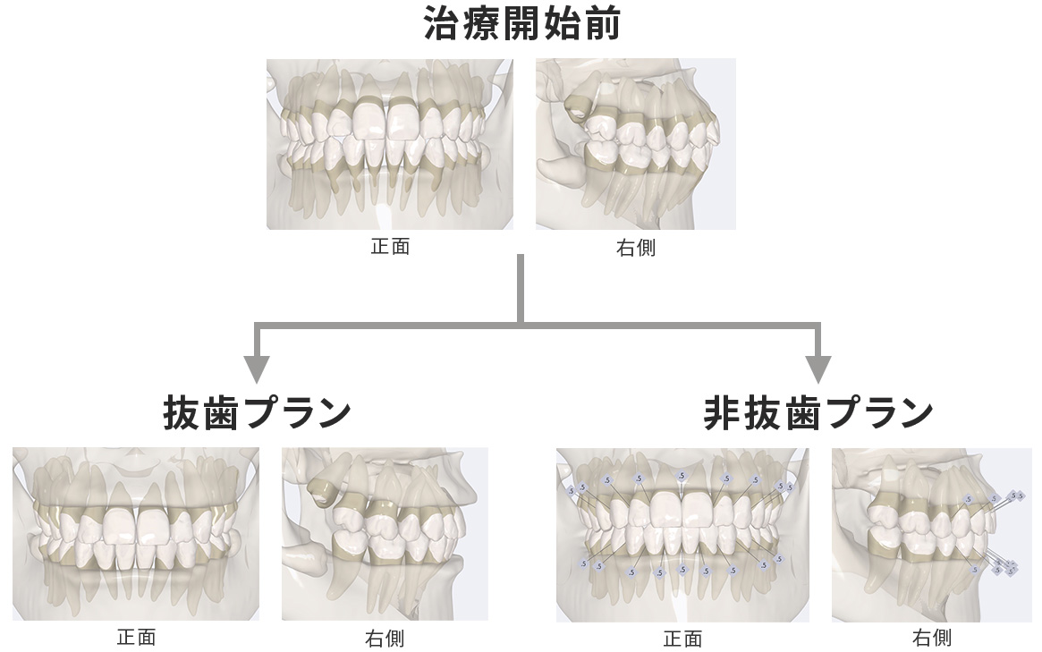 抜歯プラン＆非抜歯プランのシミュレーション