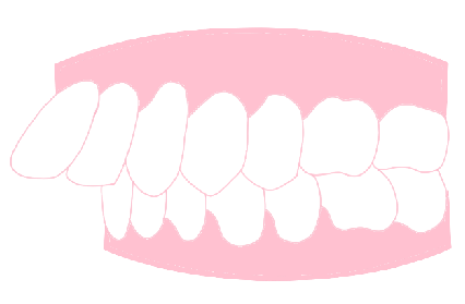 出っ歯・ロゴボ