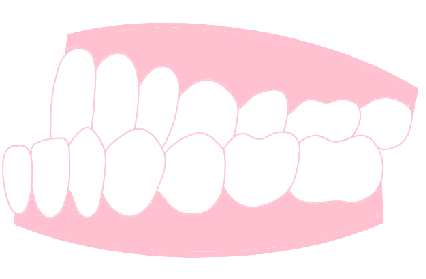 受け口・しゃくれ
