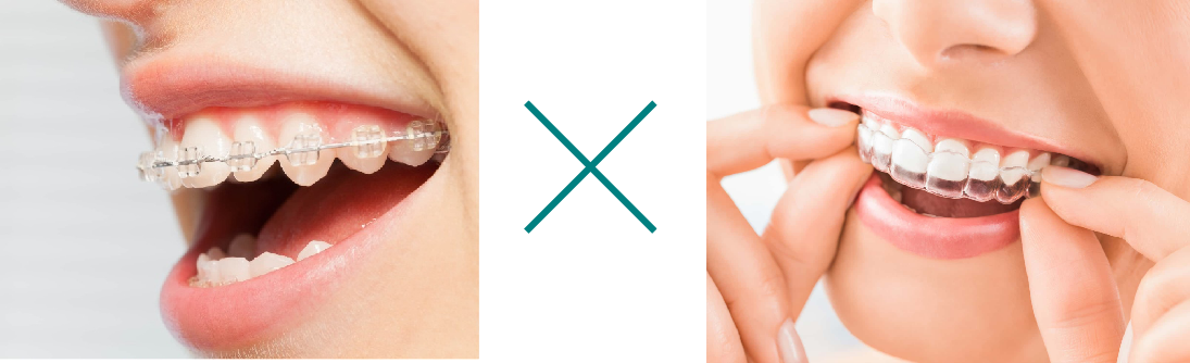 ワイヤー＋マウスピース型矯正