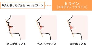 Eライン（エステティックライン）の解説図 ― 鼻先と顎先を結んだ横顔の基準線