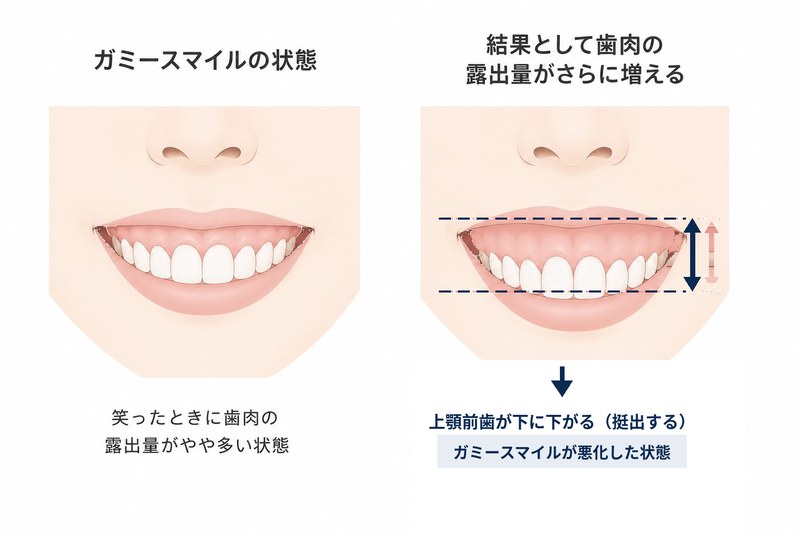 ガミースマイルの状態と、上顎前歯の挺出によって歯肉露出量がさらに増える悪化メカニズムの解説図