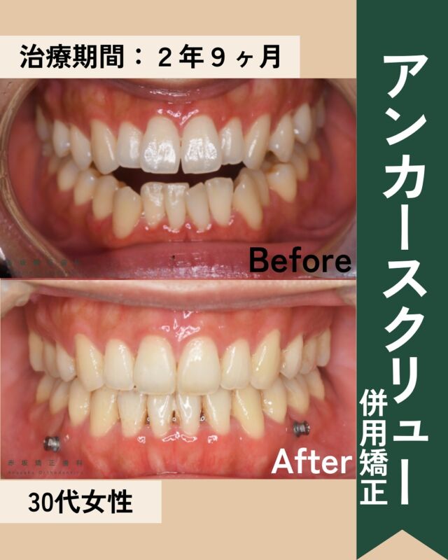 【矯正症例01】前歯で噛めない、出っ歯を治したい

■治療名　
表側ワイヤー矯正治療
歯科矯正アンカースクリュー併用４本

■患者情報　
30代女性

■担当医　
Dr黒岩

■診断名
開咬、出っ歯

■コメント
歯科矯正アンカースクリューにて臼歯の圧下による開口の解消を行った症例です。
臼歯の圧下を行う事により下顎が上手く収まり、かつ抜歯の併用により、前歯がしっかり噛めるようになっています。
また、主訴である出っ歯感の改善を行いました。

■治療期間
2年9ヶ月

■治療費用(税込)
1,045,000円　※トータルフィー（処置料、保定装置代金など含む)
＋176,000円(アンカースクリュー4本のオプション費用)

■リスク
治療後の後戻り、歯肉退縮、歯根吸収などの可能性

他の投稿を見るときはここをタップ
↓↓
@akasaka_kyousei
ご質問DMも受付中

─　─　─　─　─　─

◇赤坂矯正歯科◇

〒107-0052
東京都港区赤坂6-3-16
赤坂ストリートビルディング1F
☎︎03-6230-9959
LINE相談 @873isrts

─　─　─　─　─　─

#スピード矯正
#マウスピース矯正　
#インビザライン　　
#小児矯正　
#ワイヤー矯正　
#裏側矯正

#定額トータルフィー　#初診相談受付中

#赤坂矯正歯科 #歯並びのことなら黒岩に聞け
#日本矯正歯科学会認定医

#歯科矯正　#歯並び　#歯列矯正　
#赤坂矯正　#赤坂見附矯正　#六本木矯正　#虎ノ門矯正　#四谷矯正　#溜池山王矯正　#西麻布矯正　#綾瀬矯正　#根津矯正